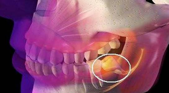 引起冠周炎症如果生长空间不足,智齿会使劲儿顶住相邻的牙齿继续生长