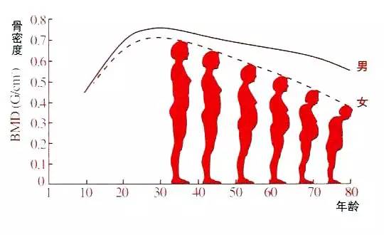 28岁年轻小伙子的骨密度,与58岁老太太的骨密度值一样,这也不是什么