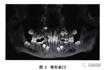 伴恒牙缺失和锥形侧切牙的多颗乳磨牙下沉1例