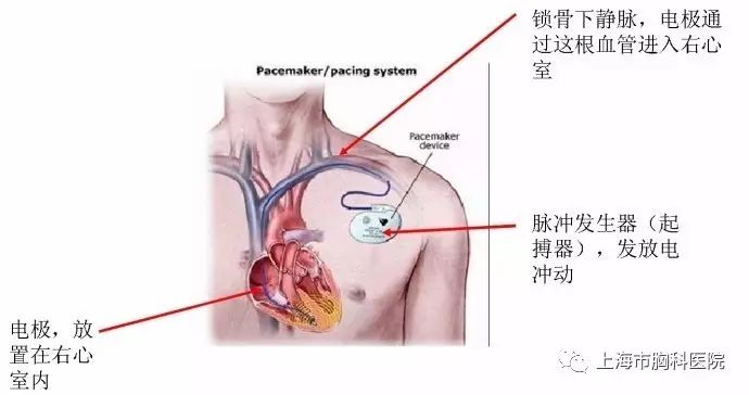 心脏除颤的作用原理_吴立群 易损性上限的电生理机制及临床评估除颤效用性的指导价值 上海