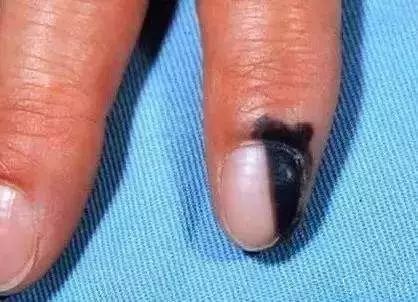 娱乐 正文  一般来说,良性的甲母痣所引起的指甲黑线宽度不会超过5