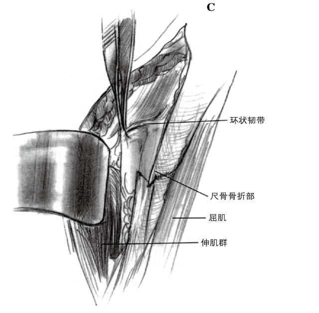 c从尺骨外侧面小心剥离伸肌,显露环状韧带的近端桡骨干和尺骨部.