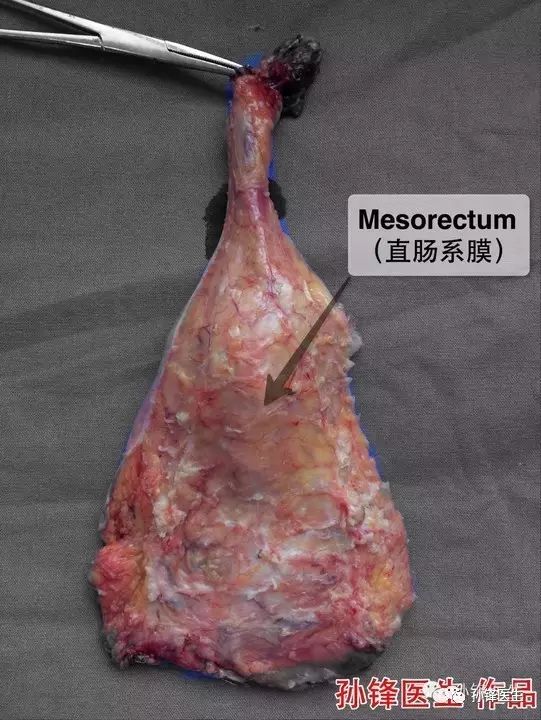 直肠从腹膜反折以下作为腹膜后位,传统解剖意义上没有系