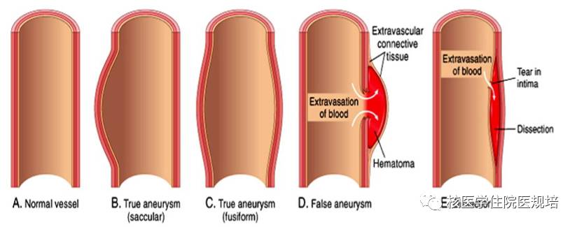 主动脉夹层:主动脉壁中膜弹力纤维病变或