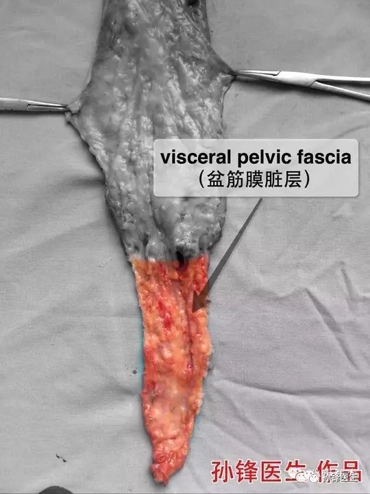直肠系膜的解剖(2:盆筋膜脏层(直肠固有筋膜)tme手术除原发肿瘤切除