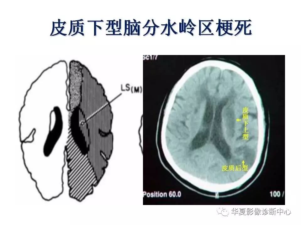 【影像基础】详细的分水岭脑梗塞讲解,值得收藏