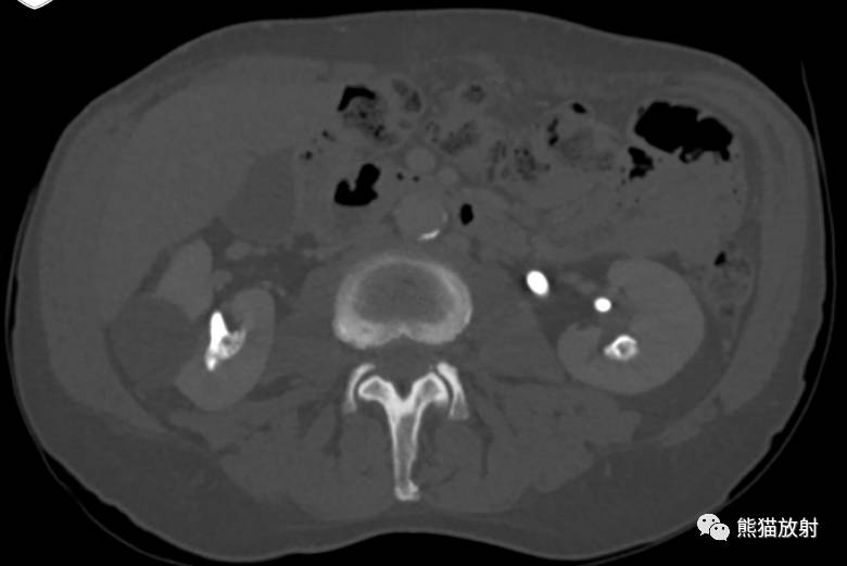 ivp-ct