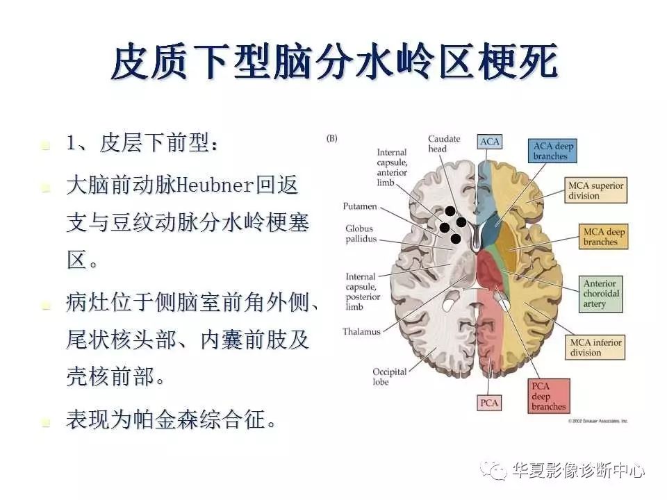 【影像基础】详细的分水岭脑梗塞讲解,值得收藏