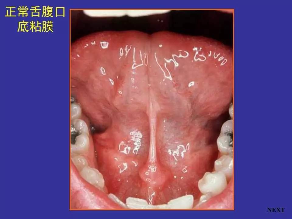 多图连载（二）：口腔黏膜感染性疾病及溃疡类疾病图示_手机搜狐网
