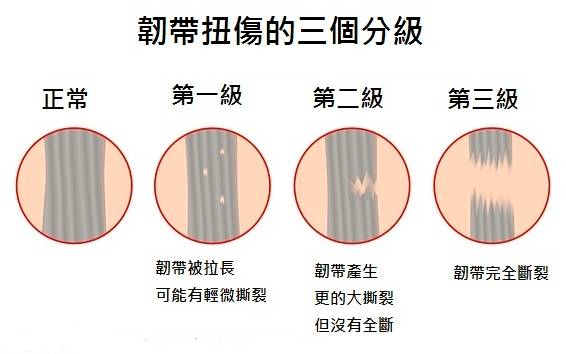 脚踝扭伤该如何进行康复治疗?