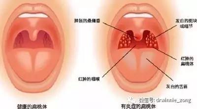 检查可见扁桃体充血,肿大,化脓严重时高热不退,吞咽困难表现为发热