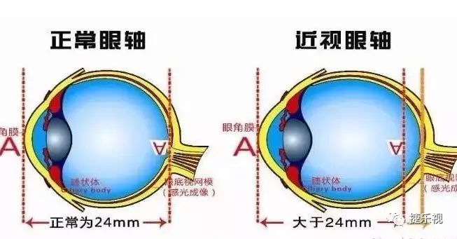 【视光知识】长时间近距离用眼是引起近视的根本原因