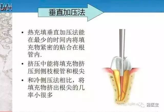 dxm帝美热牙胶充填系统轻若鸿毛舒适操作精准控温