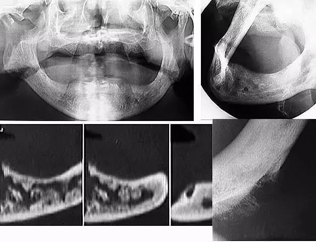 骨髓炎球状上颌囊肿含牙囊肿涎石病颌骨纤维性结构不良症涎石病骨肉瘤