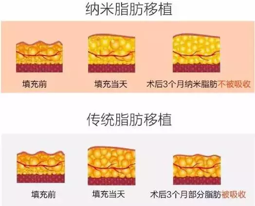 因此需要用较粗的注脂针进行脂肪移植,也只能填充因脂肪或者肌肉萎缩