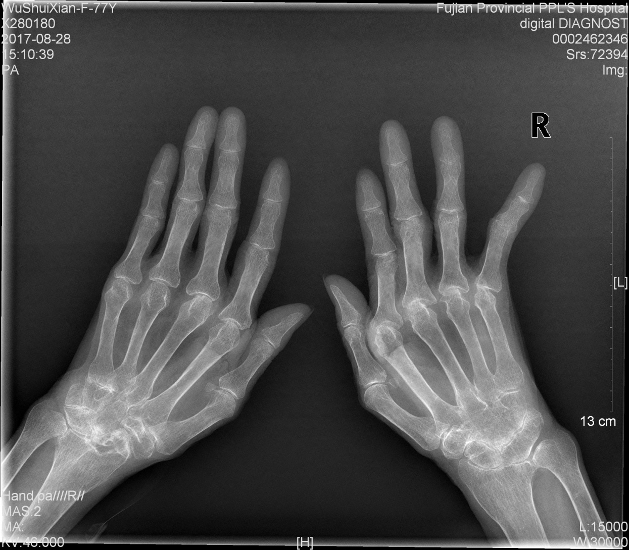 双手掌正位x线:双手,双腕关节符合类风湿关节炎改变.