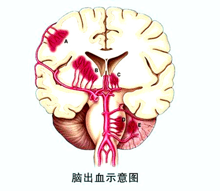 【组图】因为脑出血,有人遭受病痛有人丢了性命!