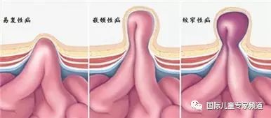 二,我宝宝疝气嵌顿了,怎么办呢?