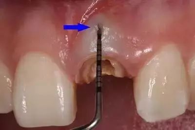 【知识】根管侧穿时修补方法