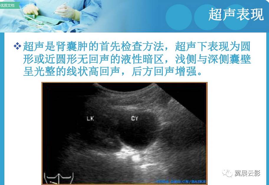 肾囊肿的影像学表现