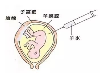 唐筛高危,做羊水穿刺的孕妇要做好哪些准备?