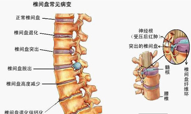 腰椎间盘突出症是什么病?