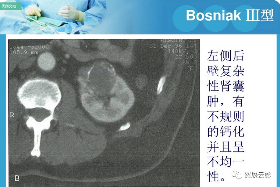 肾囊肿的影像学表现