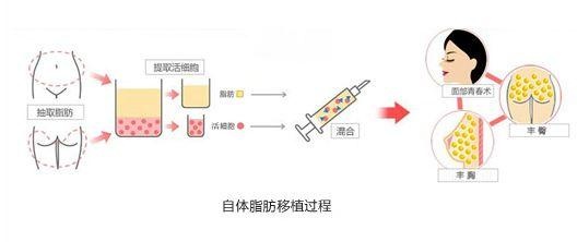 自体脂肪填充是在脂肪抽吸术基础上完成的一项手术,先把人体肥胖部位