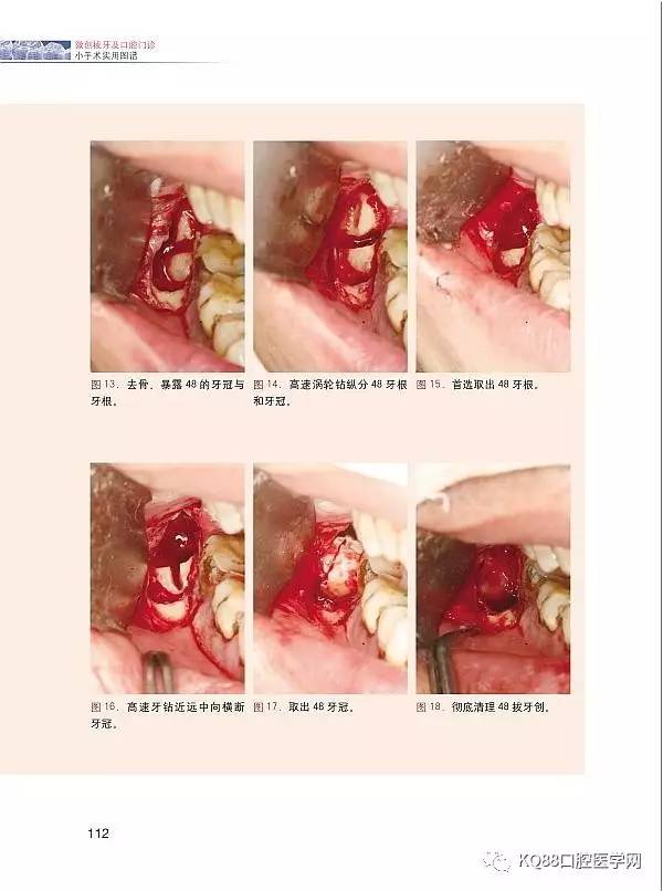 书内容包括:2000多张临床彩色图片,涵盖阻生牙,埋伏牙,复杂牙,正畸牙