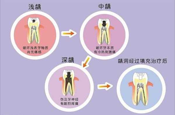 龋齿演变过程,牙齿健康很重要 五,如何预防蛀牙