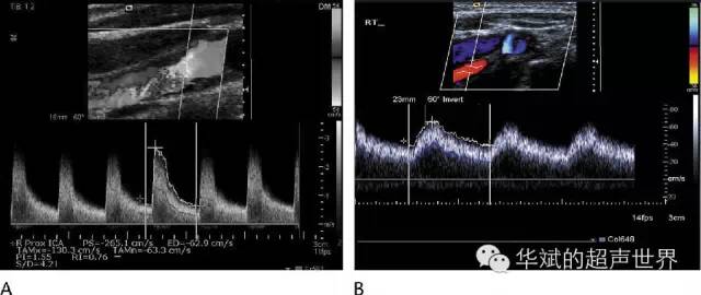 超声微课堂异常动脉频谱小慢波