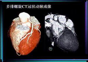 冠心病最应该做的检查—冠状动脉造影