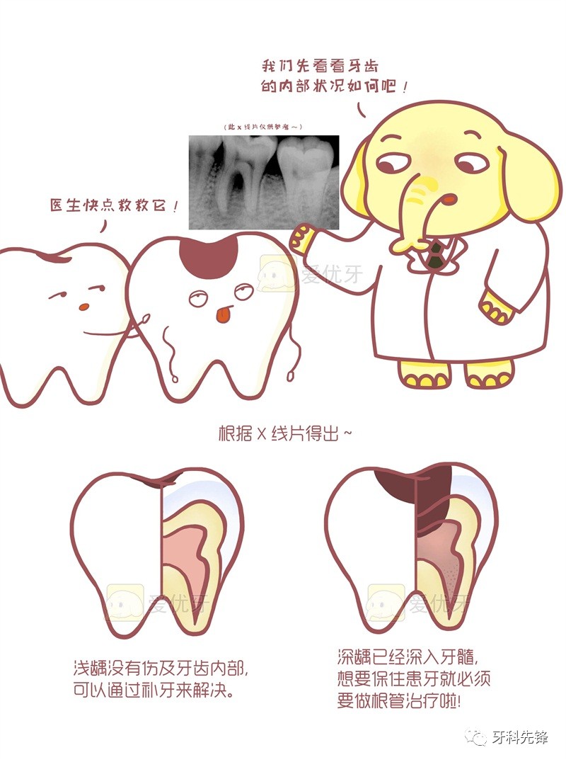 深入揭秘根管治疗!简单几步就让烂牙获得新生