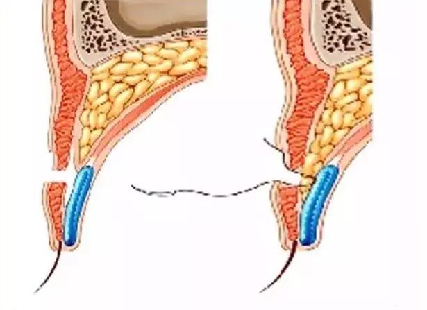 【整外干货】三眼皮修复手术过程图解