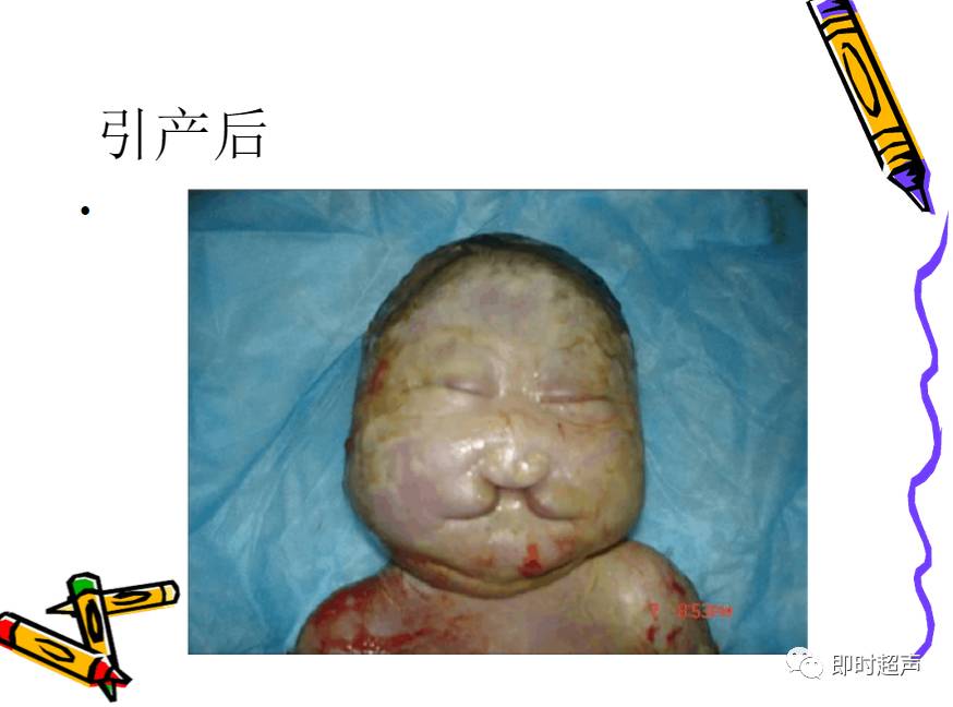 胎儿面部畸形的超声诊断