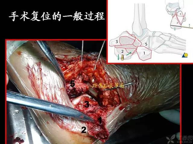 图文并茂:再谈跟骨骨折的治疗