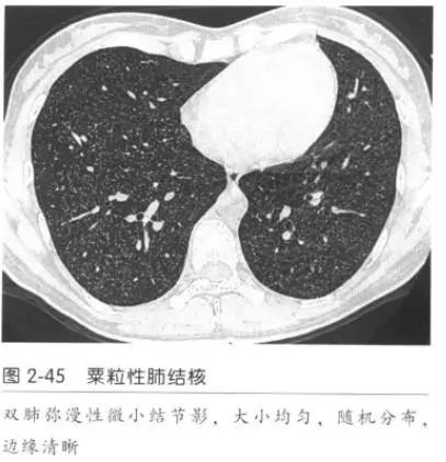 肺ct征象:如何夜观天象(有文献依据),看肺ct,治肺病