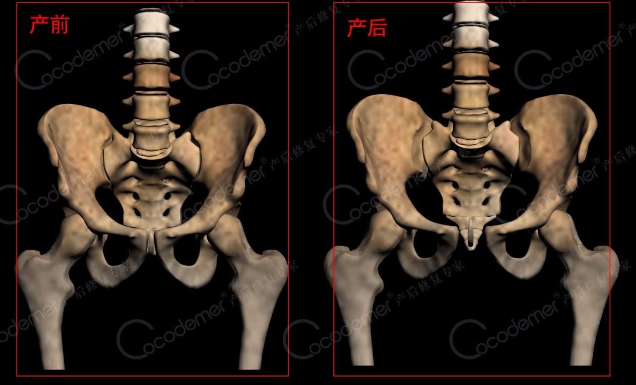 骨盆那些事儿:骨盆错位是女性疾病根源