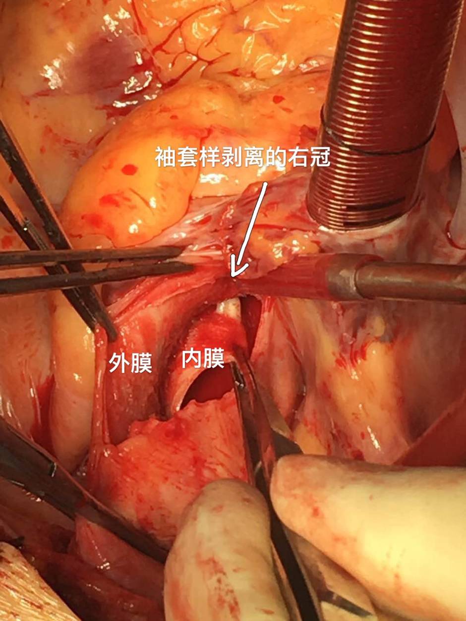 26岁a型主动脉夹层患者几历生死,心血管中心合力抢救