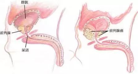" 前列腺癌是全球范围内男性第二位常见癌症,其在国内的发病率年均