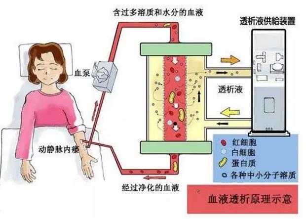 血液透析是通过应用人工透析器和透析机帮助尿毒症患者清除体内的