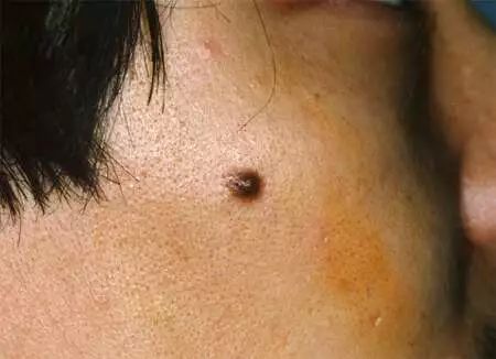 有了这个技术之后,皮肤五大疾「痣疣瘤斑藓」就很容易