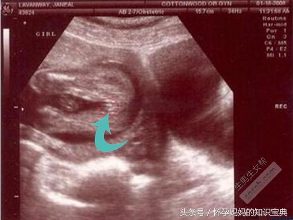 2,9w 4d的bc数据: 宫内见46.6*30.2mm孕囊 双胞胎都是女孩.