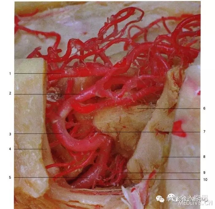 大脑中动脉分段详解简图dsa实体解剖