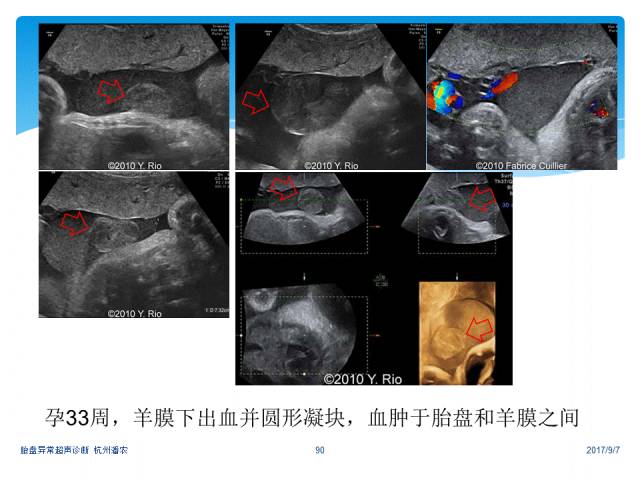 超声微课堂胎盘异常的超声诊断思路羊膜腔异常回声光带