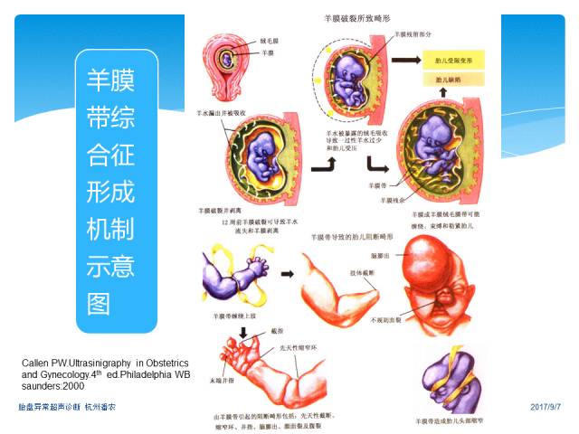 超声微课堂胎盘异常的超声诊断思路羊膜腔异常回声光带