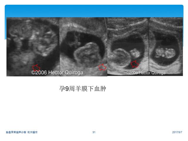 超声微课堂胎盘异常的超声诊断思路羊膜腔异常回声光带