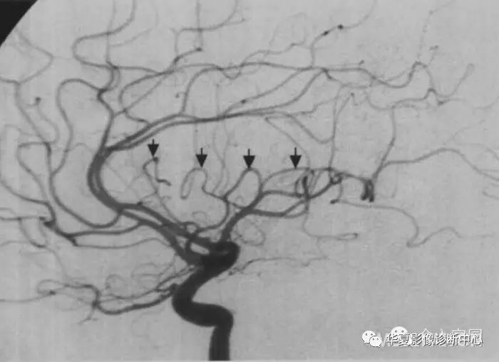 大脑中动脉分段详解简图dsa实体解剖