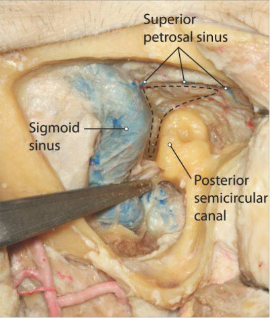 标准经岩骨后方入路操作技巧丨the neurosurgical atlas全文翻译