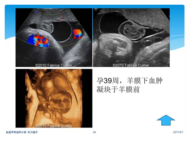 超声微课堂胎盘异常的超声诊断思路羊膜腔异常回声光带